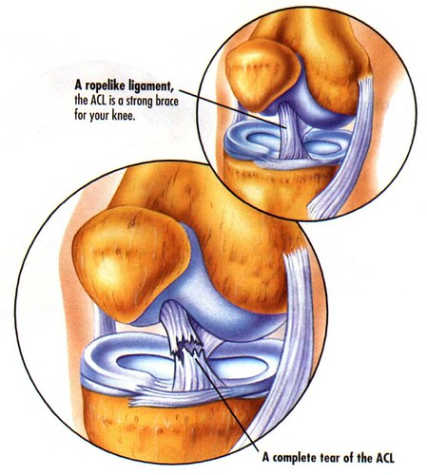 A diagram of a complete ACL tear